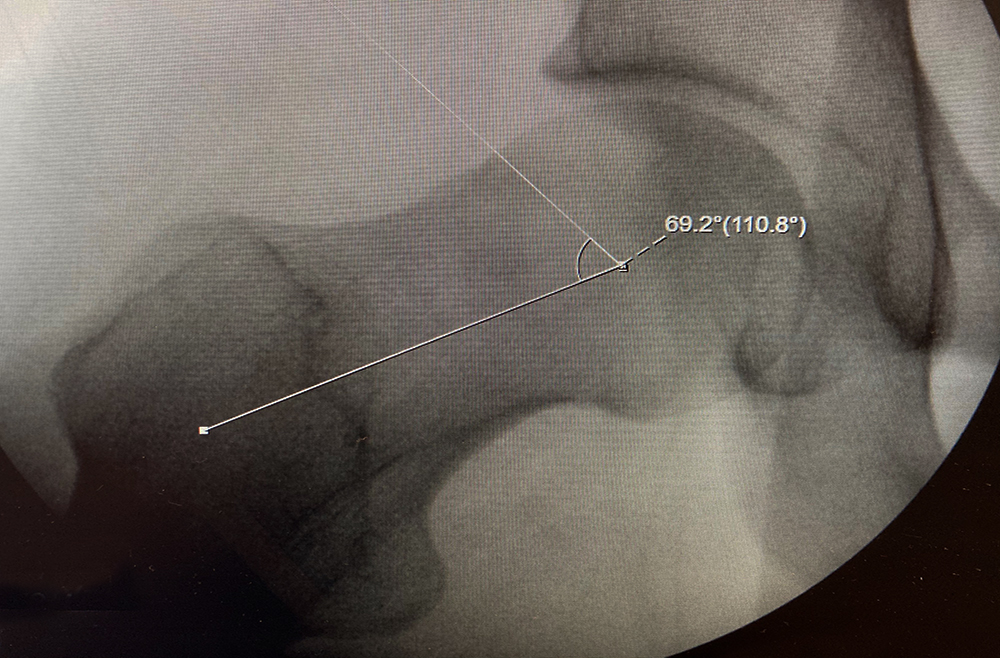 CAM impingement of the femoral head